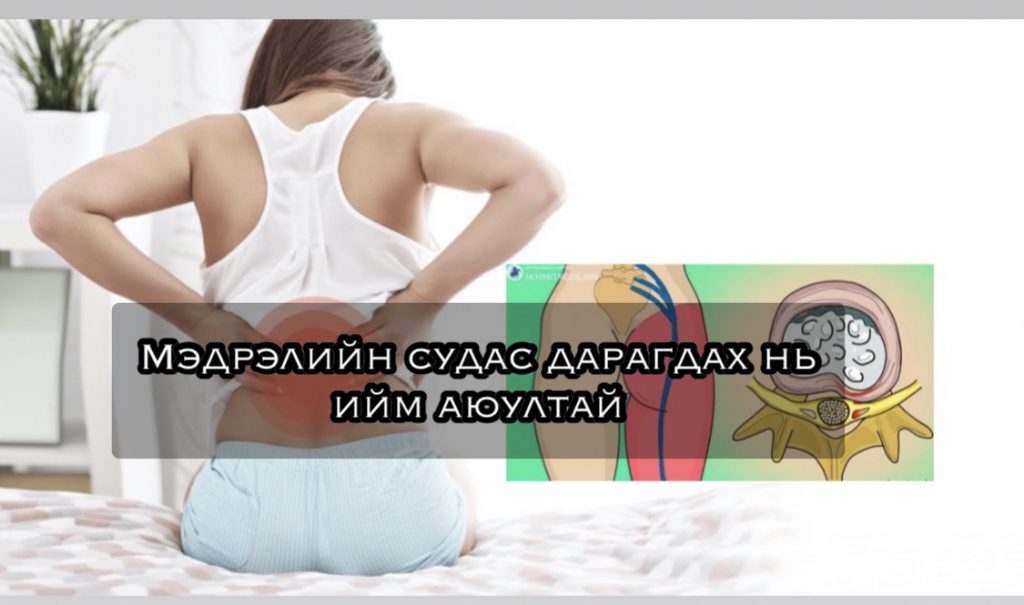 Мэдрэлийн судас дарагдах нь аюултай